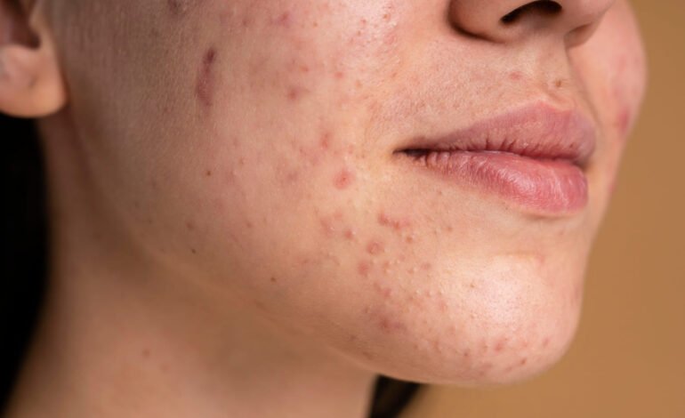 confident-young-woman-with-acne-close-up (1)