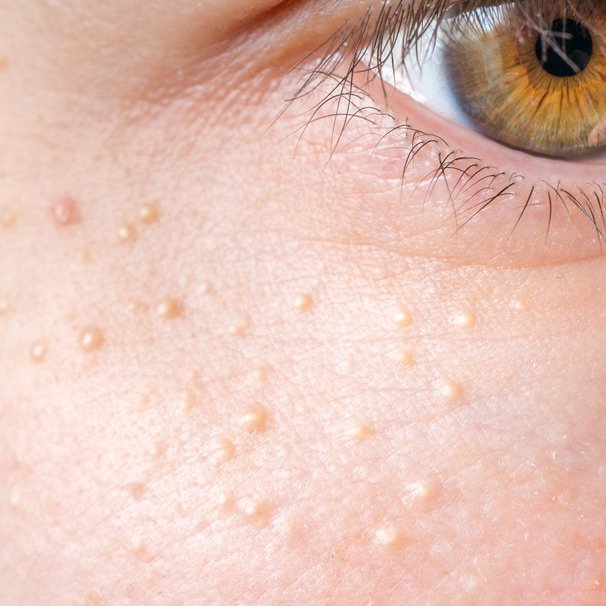 Apa Itu Milia Pada Kulit dan Bagaimana Mengatasinya?